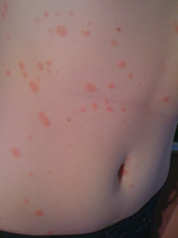 Red Dry Patch On Breast