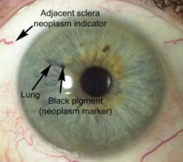 Iridology Eye picture with notes